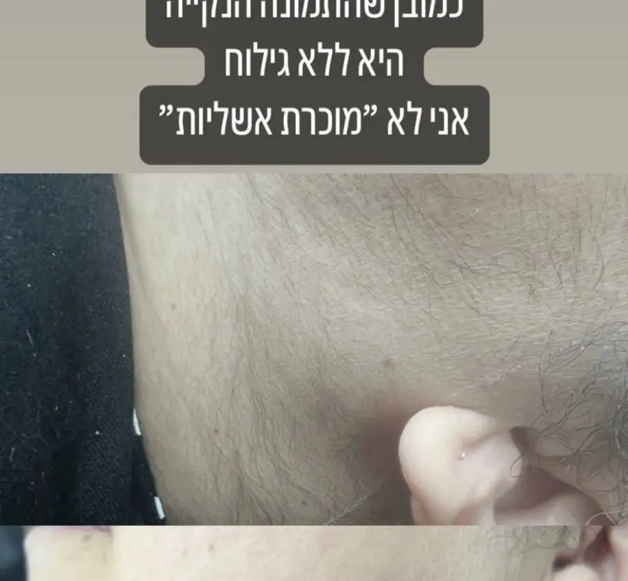 תוצאת טיפול לייזר — פנים · שיער פלומתי