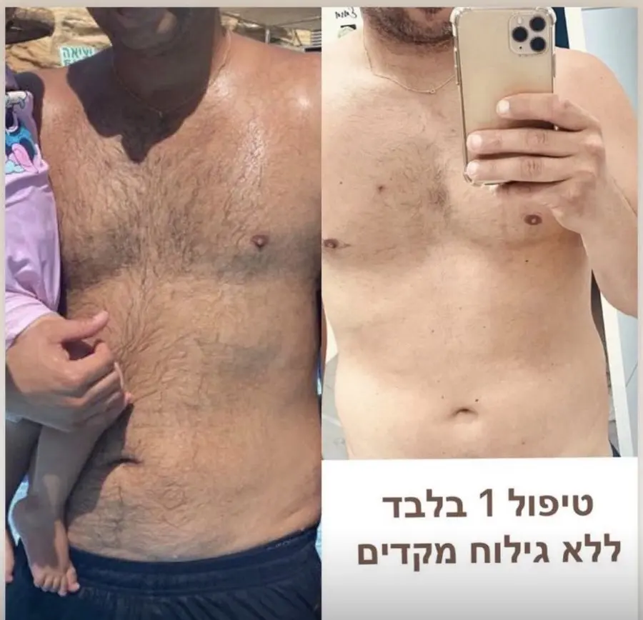 תוצאת טיפול לייזר — חזה ובטן