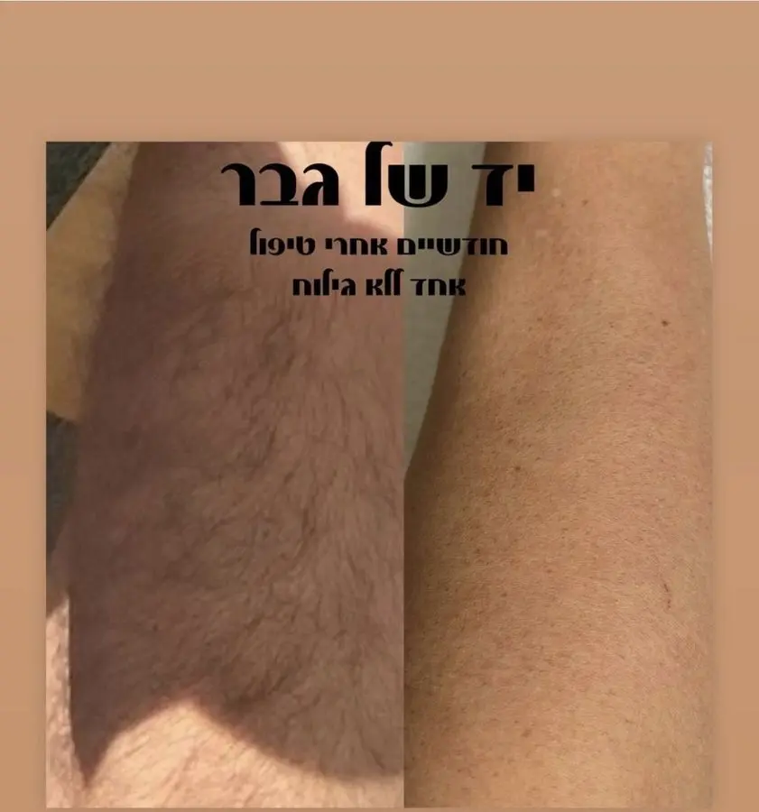 תוצאת טיפול לייזר — בית שחי