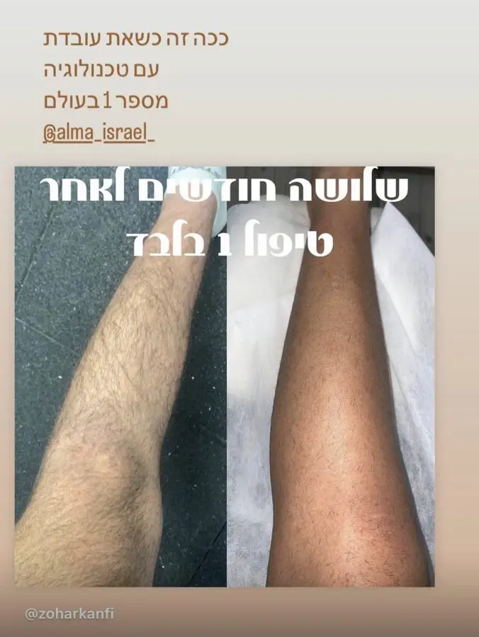 תוצאת טיפול לייזר — רגליים